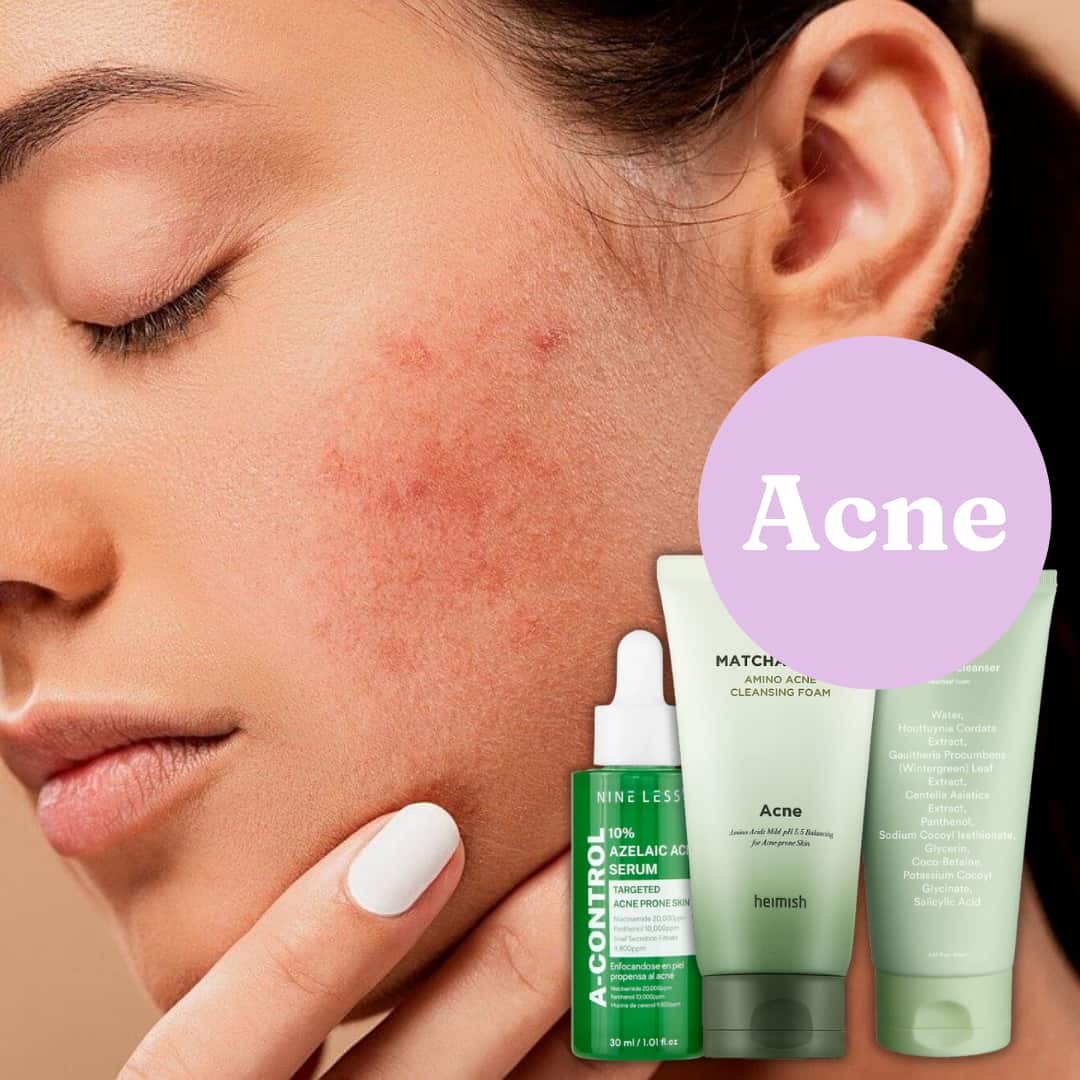 woman showing acne on cheek - bellubeauty