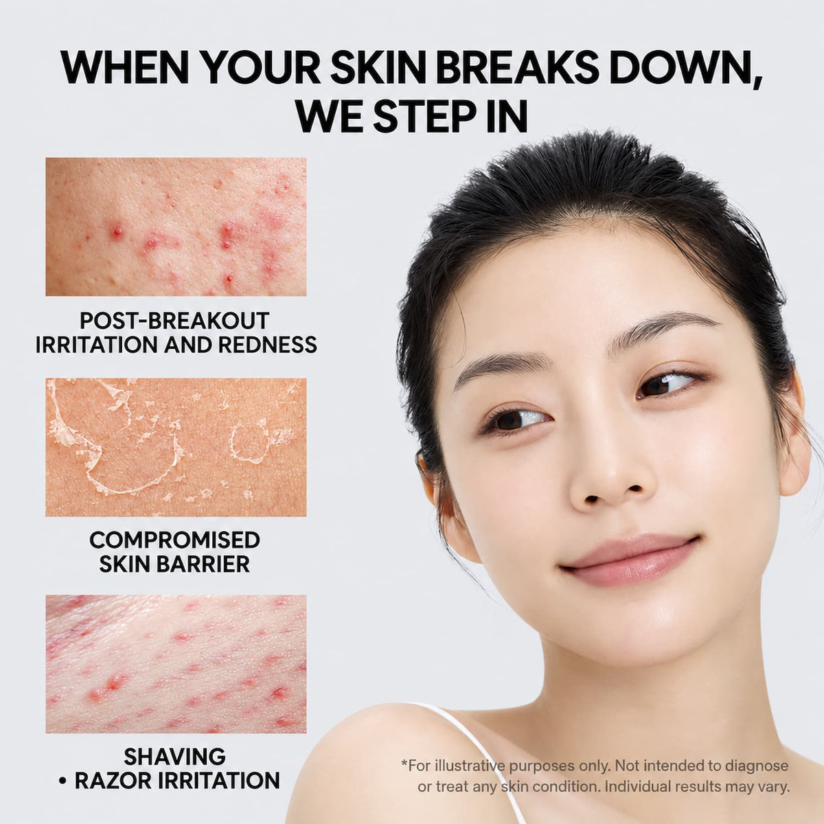 A skincare marketing graphic with a woman's face on the right and three inset skin close-ups on the left showing acne, dry cracked skin, and shaving irritation. Large text reads, 'WHEN YOUR SKIN BREAKS DOWN, WE STEP IN.