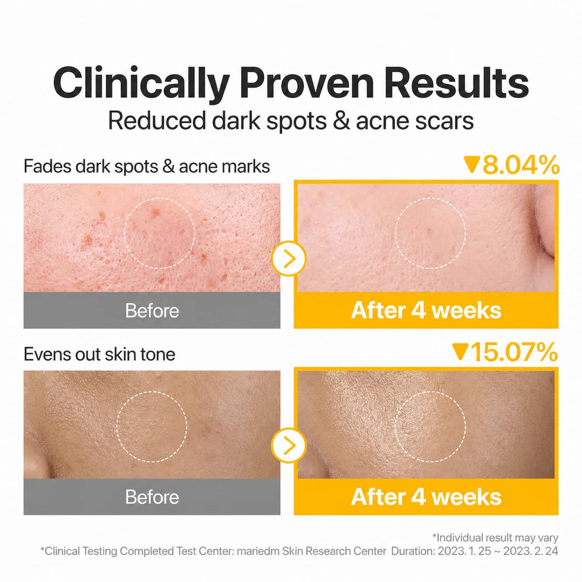 A marketing infographic showing before-and-after skin results for NUMBUZIN No.5 Glutathione Vitamin Concentrated Toner Pads. The headline reads 'Clinically Proven Results' and 'Reduced dark spots & acne scars.
