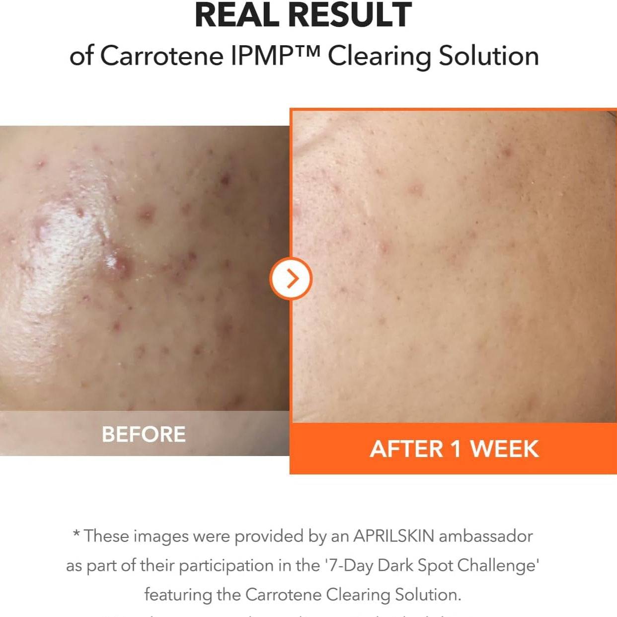 APRILSKIN Carrotene IPMP Clearing Solution 20ml - BelluBeauty